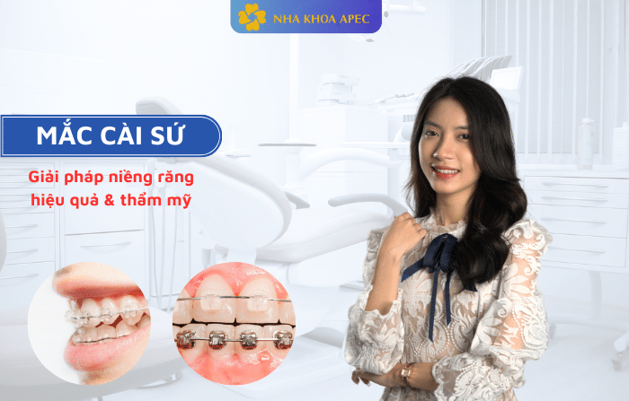 mắc cài sứ