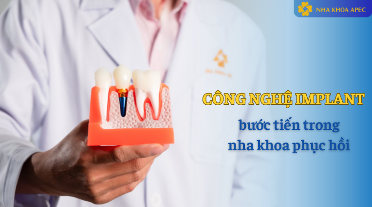 công nghệ trồng răng Implant