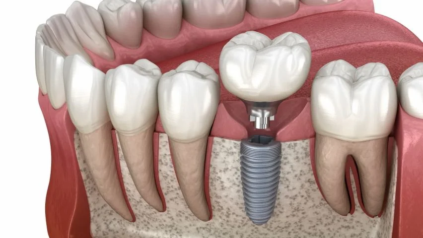 mô mềm quanh implant
