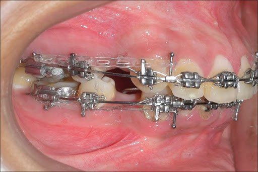 đóng khoảng trong niềng răng