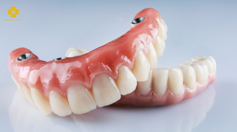 phục hình răng sứ trên Implant toàn hàm