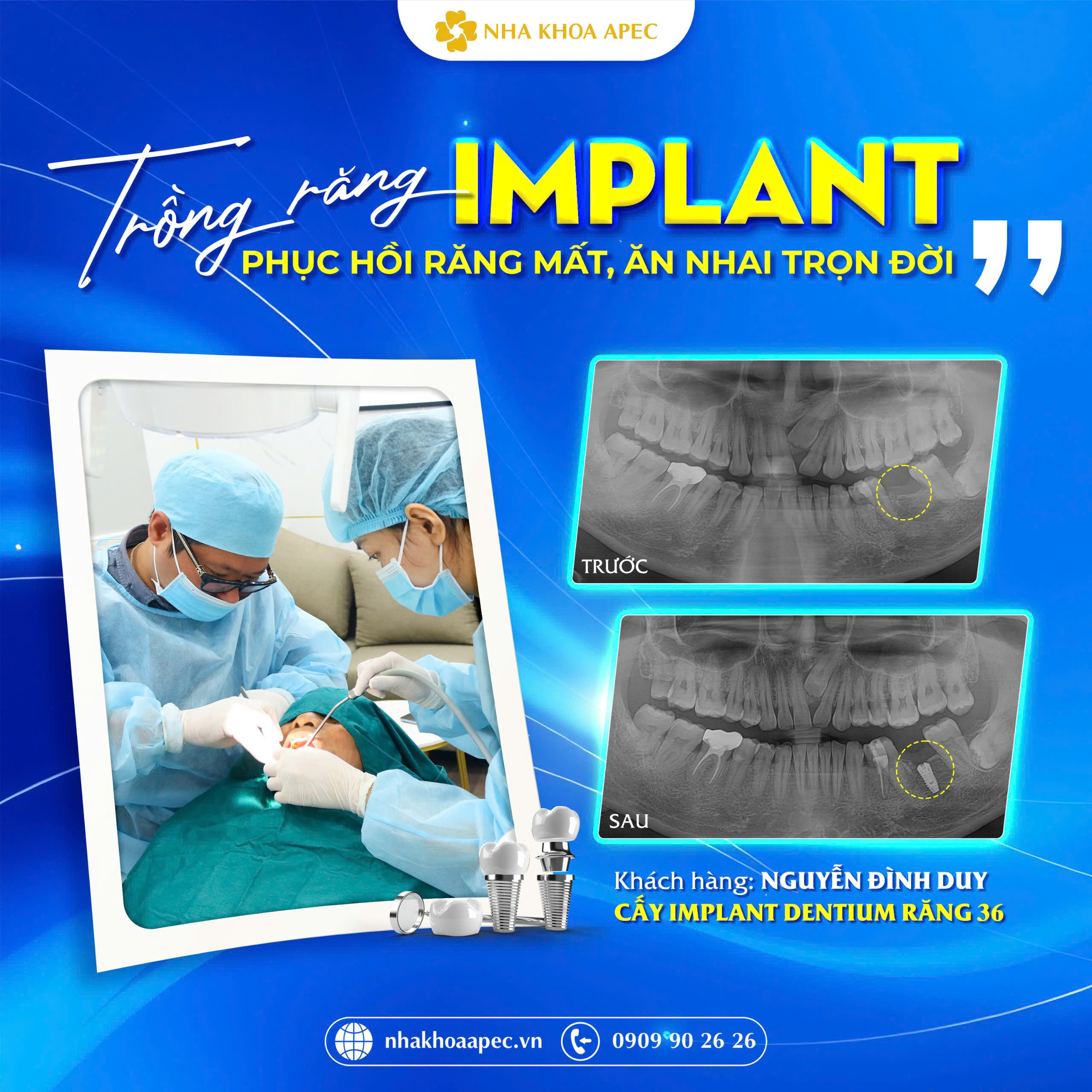 phục hình implant răng 36