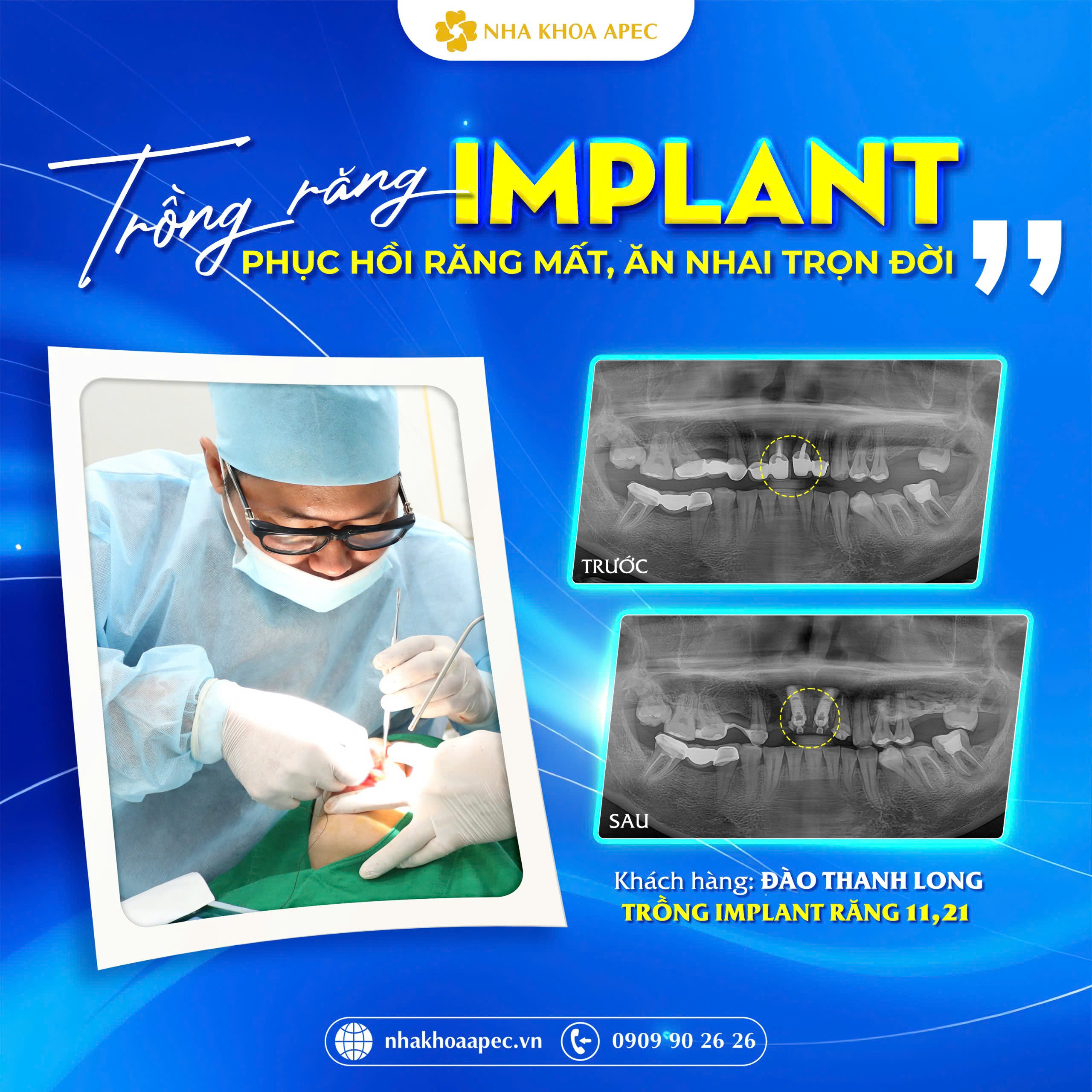 phục hình Implant cho khách hàng Đào Thanh Long