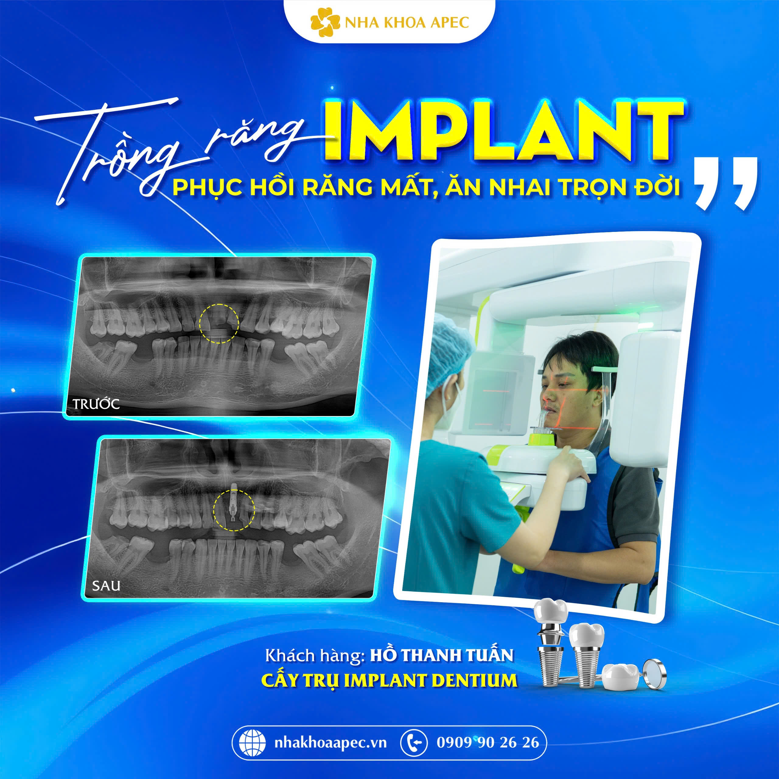 khách hàng Hồ Thanh Tuấn cấy trụ Implant dentium