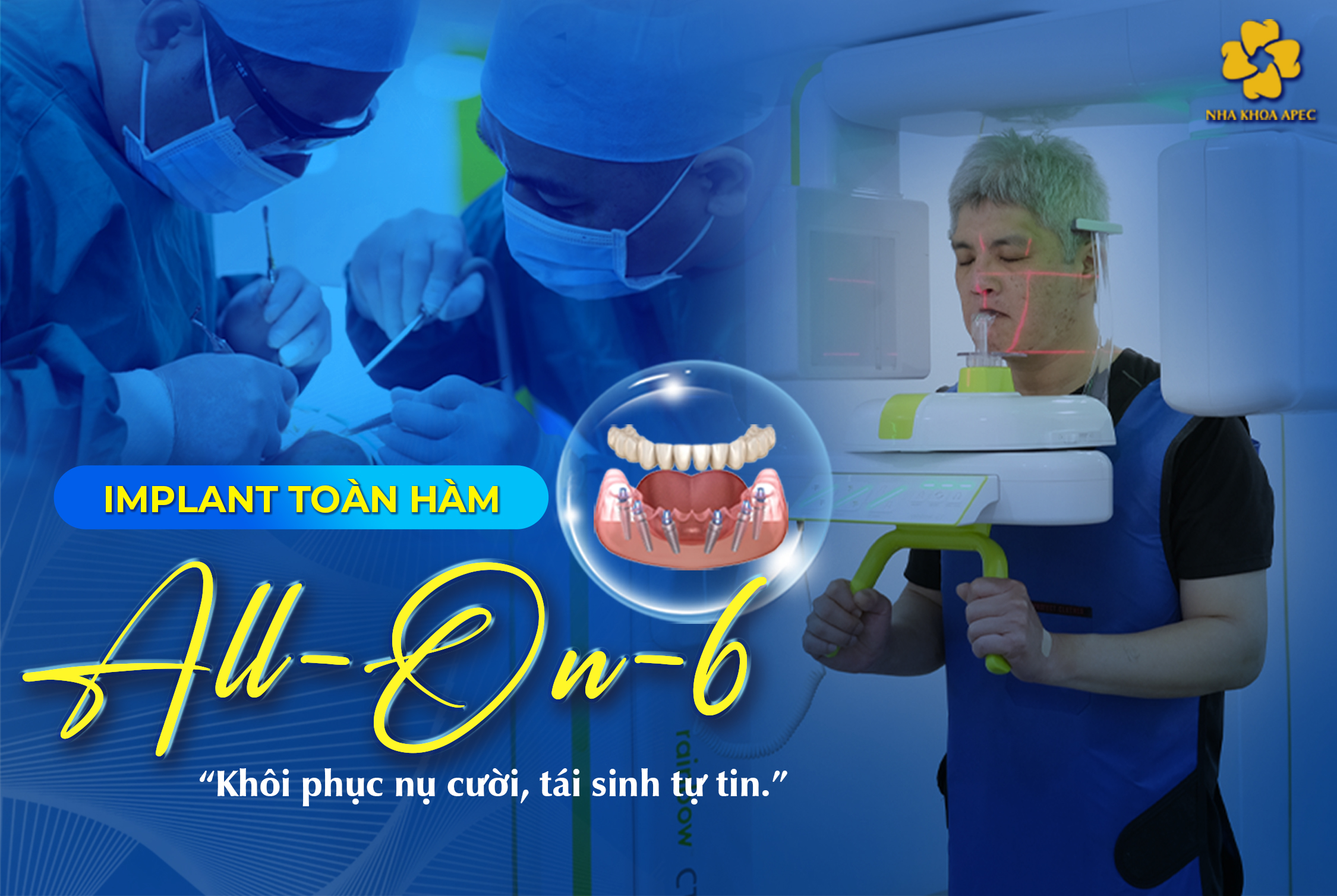 Implant all on 6