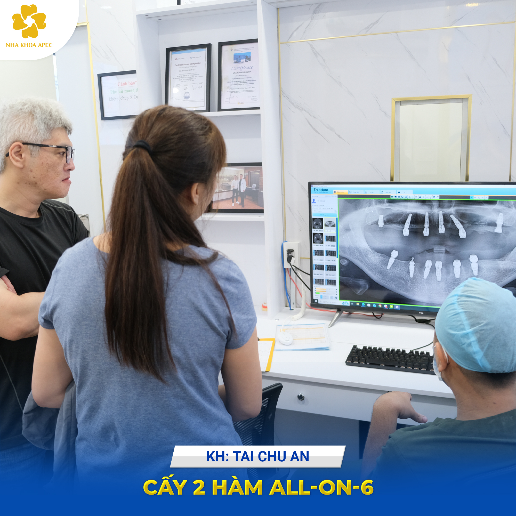 trồng răng Implant all on 6