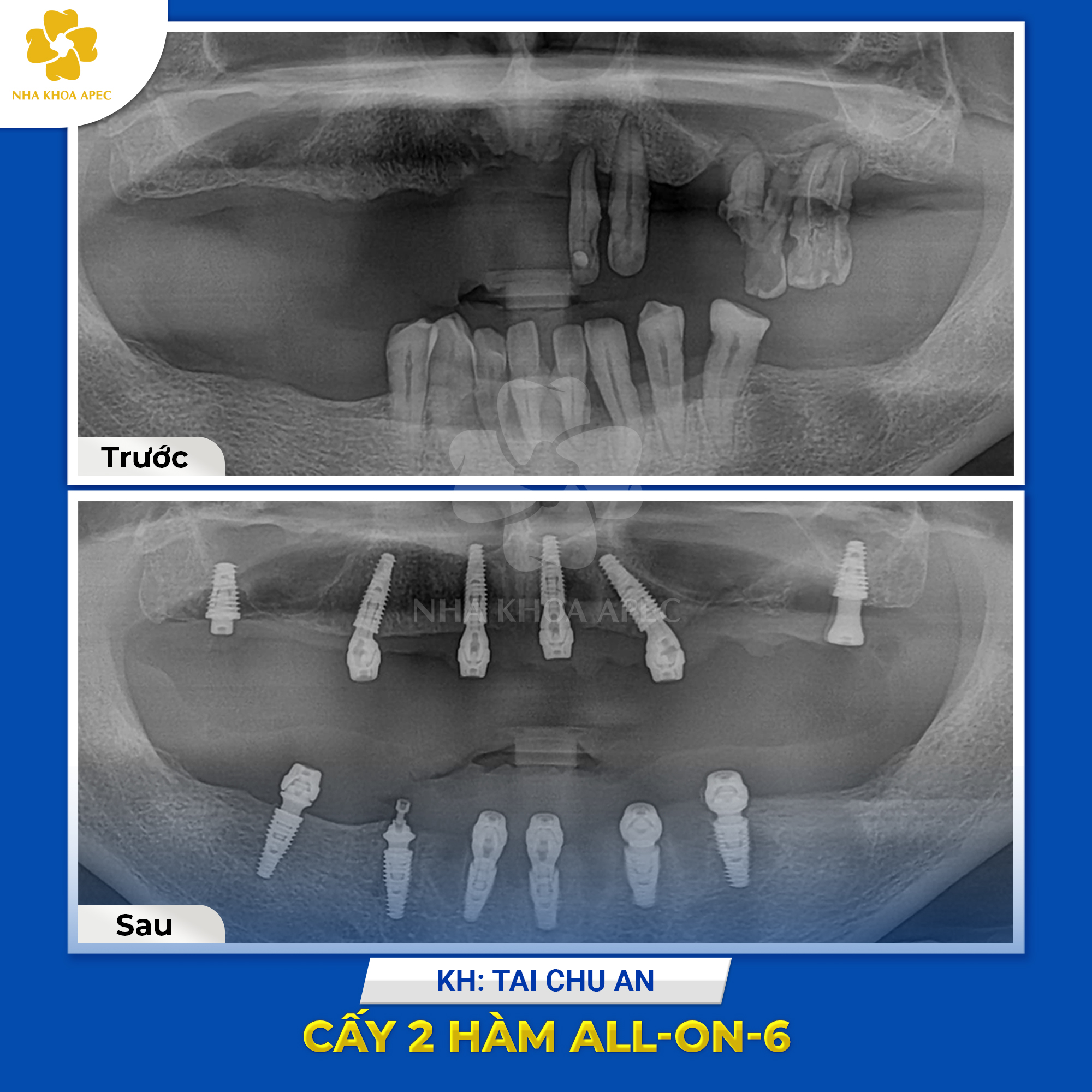 trồng Implant all on 6 cho khách hàng Đài Loan