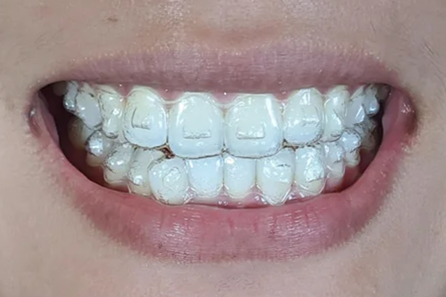 tính thẩm mỹ của Invisalign