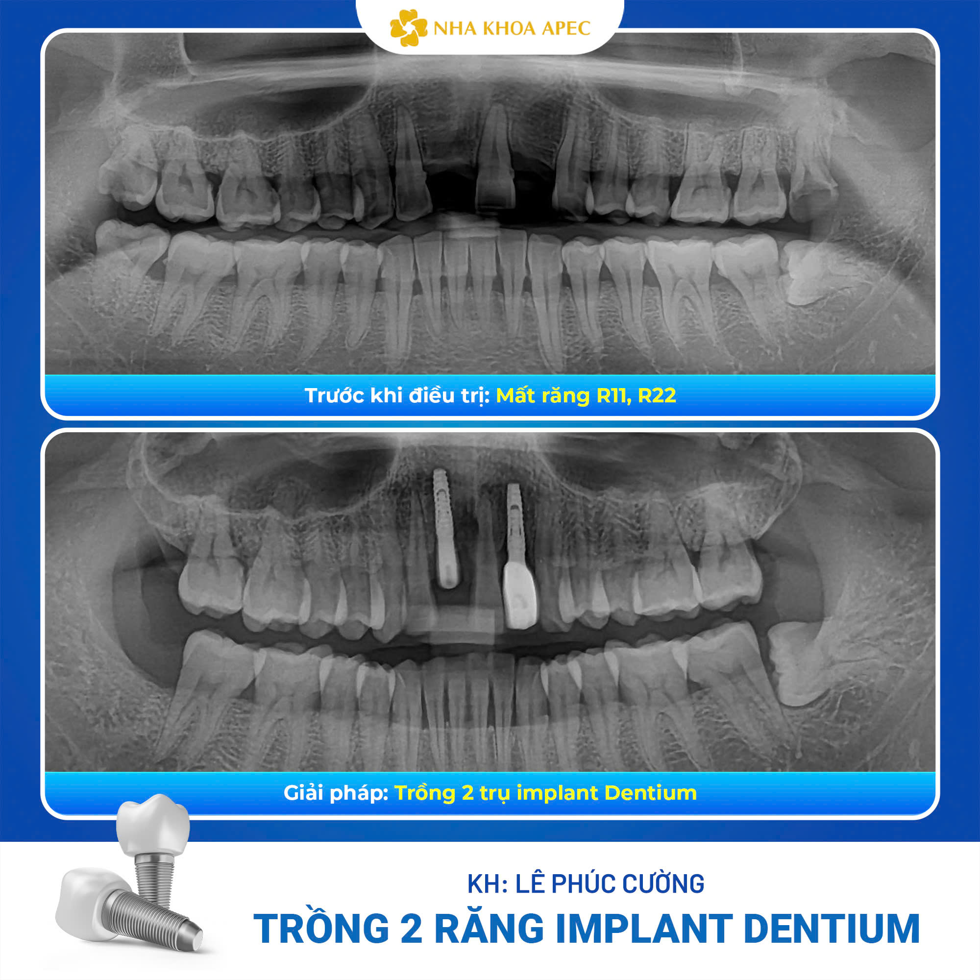 trồng Implant Dentium