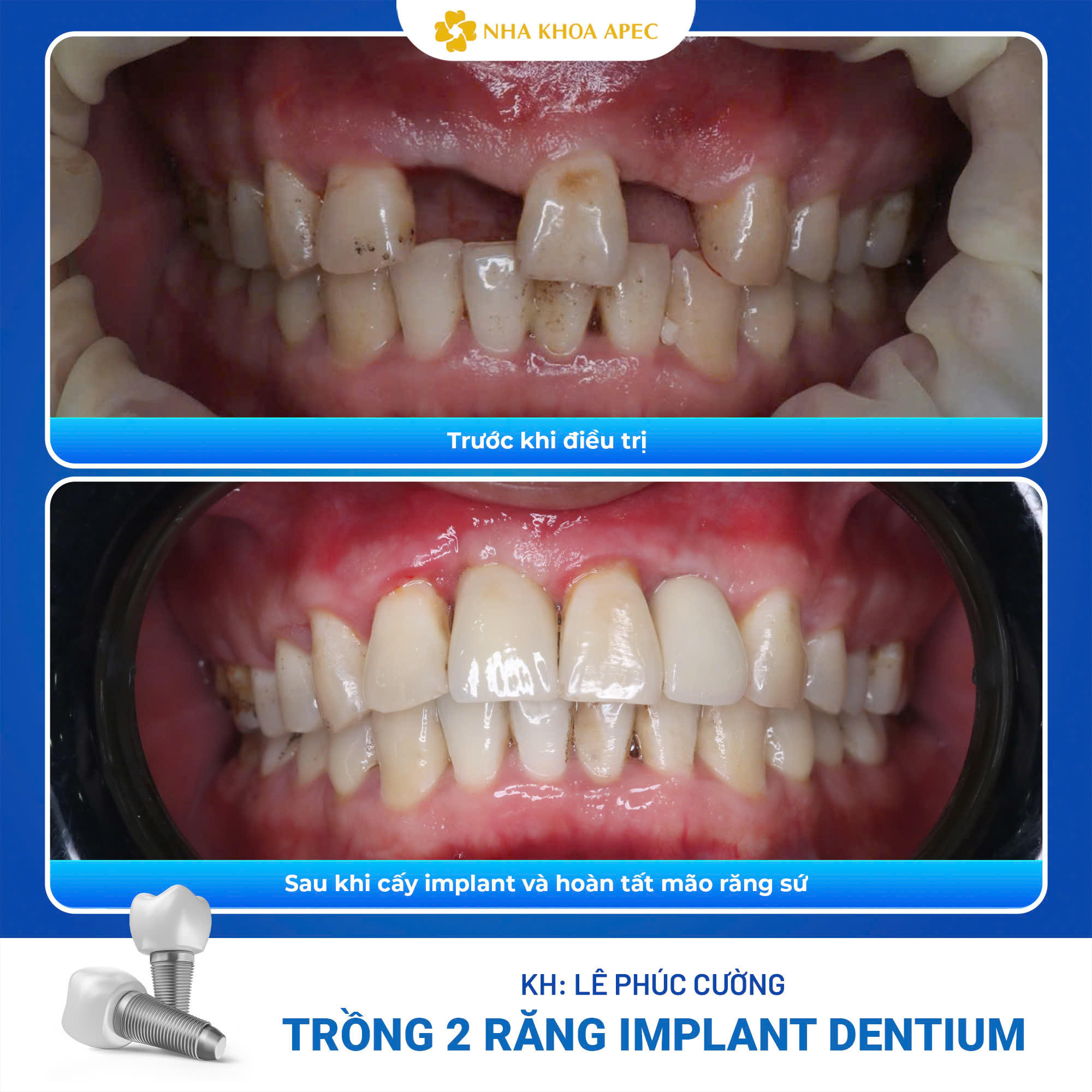 before - after khách hàng phúc Cường
